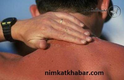 درمان آفتاب سوختگی شدید به روش خانگی