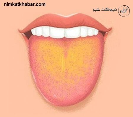 دلایل زرد شدن زبان در افراد چیست و چگونه میتوان آن را درمان کرد